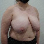 Breast Reduction Before & After Patient #1482