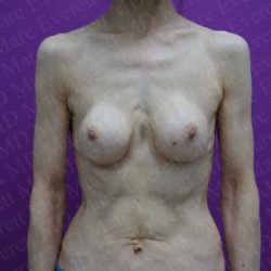 Breast Revisions Before & After Patient #2030