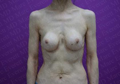 Breast Revisions Before & After Patient #2030