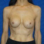 Breast Revisions Before & After Patient #2030