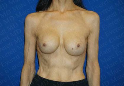 Breast Revisions Before & After Patient #2030