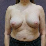 Breast Revisions Before & After Patient #2029
