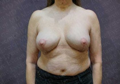 Breast Revisions Before & After Patient #2029