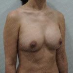 Breast Revisions Before & After Patient #2049