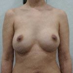 Breast Revisions Before & After Patient #2049