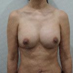 Breast Revisions Before & After Patient #2049