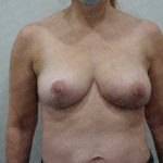 Breast Revisions Before & After Patient #2036