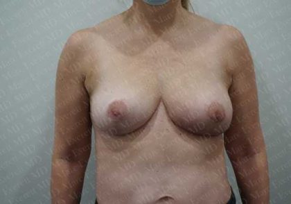 Breast Revisions Before & After Patient #2036