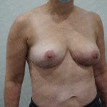 Breast Revisions Before & After Patient #2036