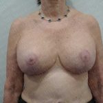 Breast Revisions Before & After Patient #2035