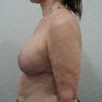 Breast Revisions Before & After Patient #2035