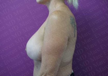 Breast Lift With Implant Before & After Patient #2034