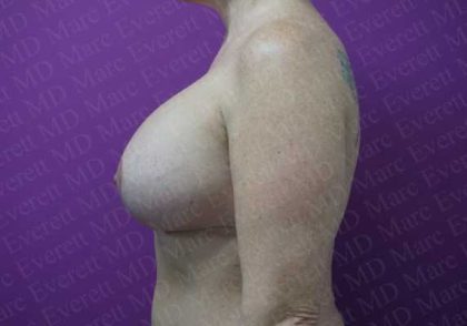 Breast Lift With Implant Before & After Patient #2034