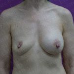 Breast Revisions Before & After Patient #2033