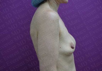 Breast Revisions Before & After Patient #2033