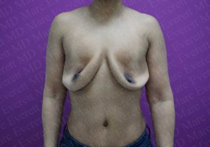 Breast Revisions Before & After Patient #2032