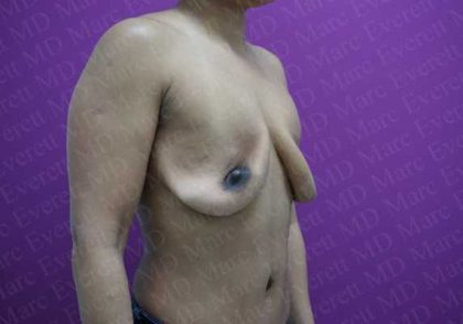 Breast Revisions Before & After Patient #2032