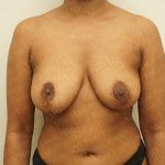 Breast Revisions Before & After Patient #2165