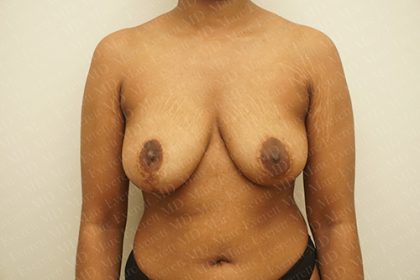 Breast Revisions Before & After Patient #2165