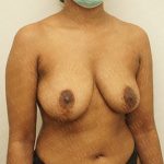 Breast Revisions Before & After Patient #2165