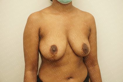 Breast Revisions Before & After Patient #2165