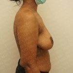 Breast Revisions Before & After Patient #2165