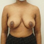 Breast Revisions Before & After Patient #2165