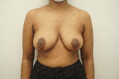 Breast Revisions Before & After Patient #2165