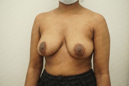 Breast Revisions Before & After Patient #2165