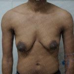 Chest Masculinization Surgery Before & After Patient #2125