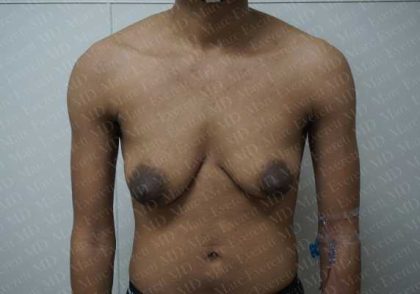 Chest Masculinization Surgery Before & After Patient #2125