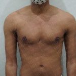 Chest Masculinization Surgery Before & After Patient #2125