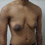 Chest Masculinization Surgery Before & After Patient #2125