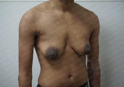 Chest Masculinization Surgery Before & After Patient #2125