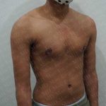 Chest Masculinization Surgery Before & After Patient #2125