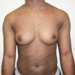 Chest Masculinization Surgery Before & After Patient #2124