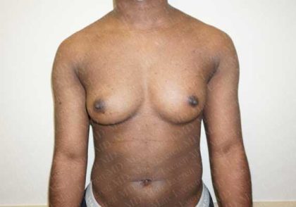 Chest Masculinization Surgery Before & After Patient #2124