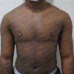 Chest Masculinization Surgery Before & After Patient #2124