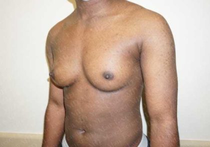 Chest Masculinization Surgery Before & After Patient #2124