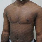 Chest Masculinization Surgery Before & After Patient #2124