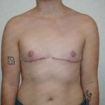 Chest Masculinization Surgery Before & After Patient #2123