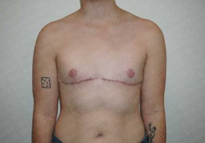 Chest Masculinization Surgery Before & After Patient #2123