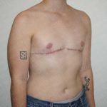 Chest Masculinization Surgery Before & After Patient #2123