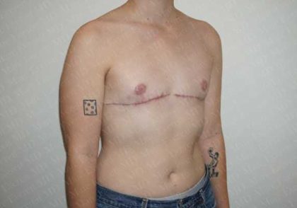 Chest Masculinization Surgery Before & After Patient #2123