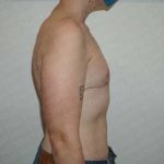 Chest Masculinization Surgery Before & After Patient #2123