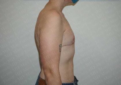 Chest Masculinization Surgery Before & After Patient #2123