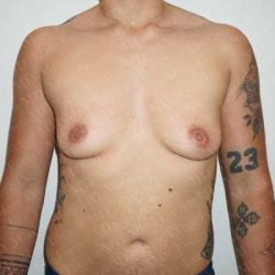 Chest Masculinization Surgery Before & After Patient #2122