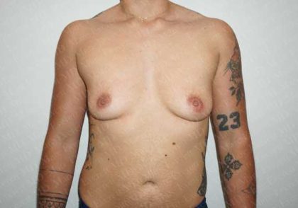 Chest Masculinization Surgery Before & After Patient #2122