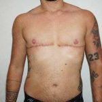 Chest Masculinization Surgery Before & After Patient #2122