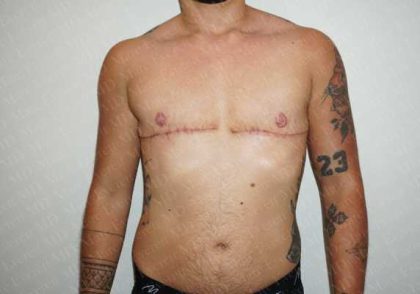 Chest Masculinization Surgery Before & After Patient #2122